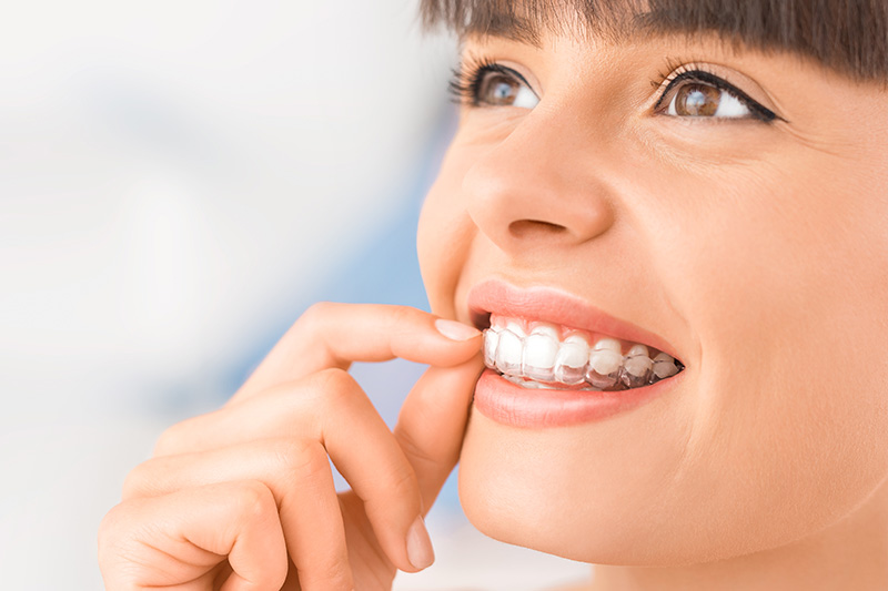 SureSmile® Clear Aligners in Slinger